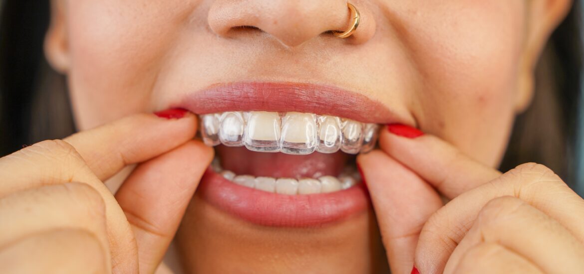 young asian woman placing her clear aligners in